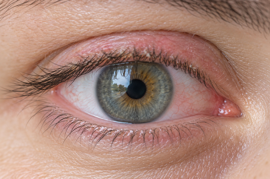 close up of eyelid margin blepharitis in contact lens wearer before eyelid hygiene routine